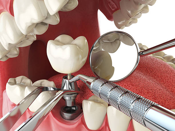 Best Emergency Treatment for Dental Infections or Abscesses in Coventry Lake, CT